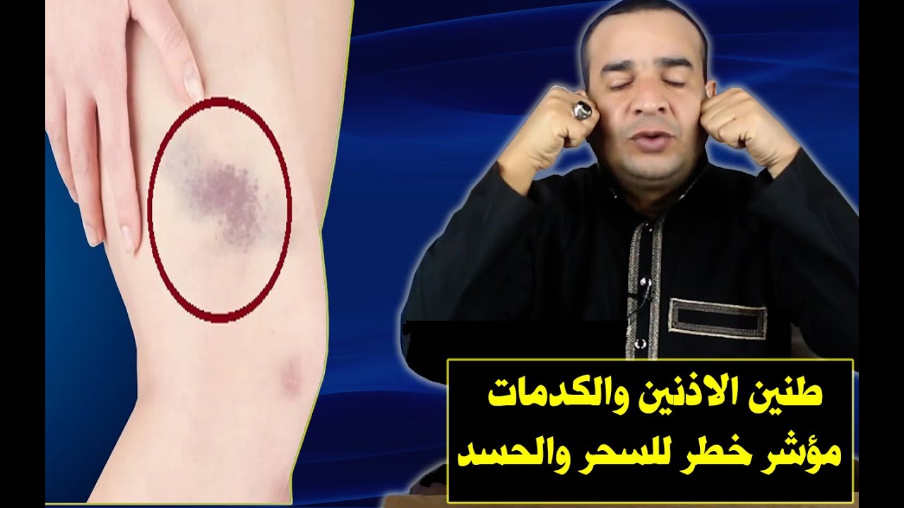 طنين الأذنين والكدمات الحمراء وعلاقة ذلك بالسحر والحسد