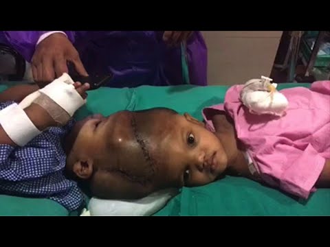 Des Docteurs Indiens Separent Des Bebes Siamois Youtube