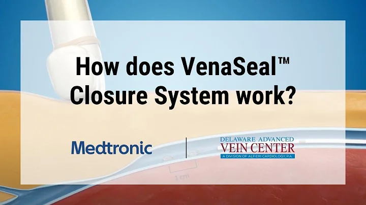 How does Venaseal Closure System Work?