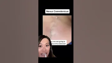 How Do You Avoid Getting These Blackheads And Whiteheads 