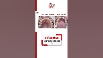 Niềng Răng Khấp Khểnh Sẽ Như Thế Nào?#shorts