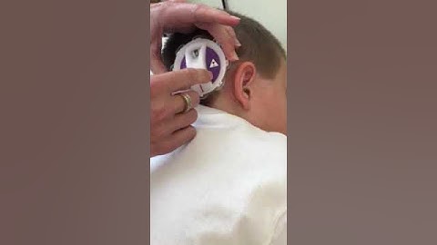 Shunt valve setting change on Coffman Certas valve 2017