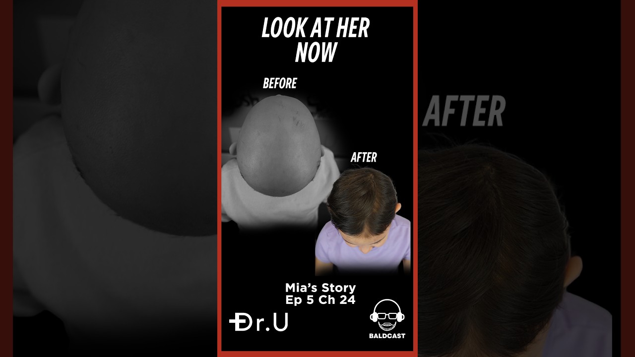 Look at Her Now: Mia’s Childhood Hair Loss Journey