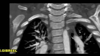 Two types of circumflex aortic arch,,From my archive