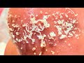Blackheads Extractions |