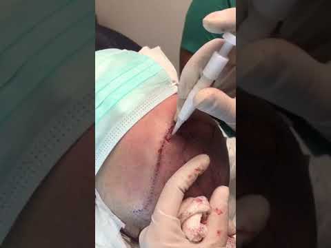 DHI Turkey | Direct Hair Implantation Turkey | Hair Transplant | Dr. Emrah Cinik