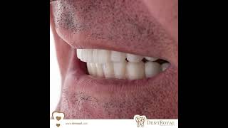 In This Way We Used 10 Dental Implants And 28 Zirconium Crowns For Getting Perfect Result.
