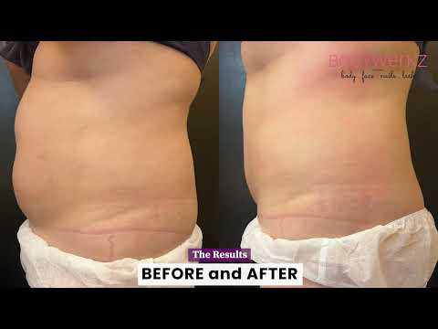 Body Slimming with Lipo Killer 80k - video from BodyPerfect