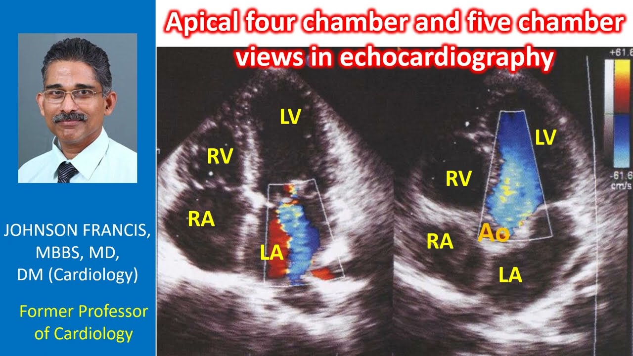 Transthoracic Echocardiogram Of Apical Fivechamber View 2809x2632