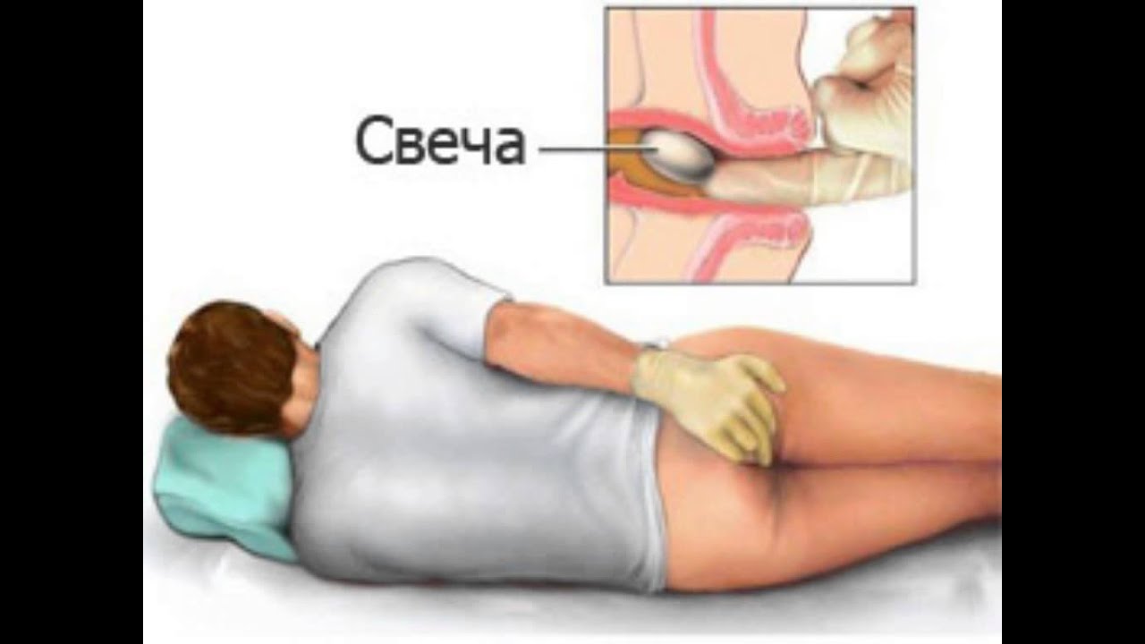 Девушке вставили свечку. Как вводить свечи ректально. Что такое ректальное Введение свечей. Введение свечи в прямую кишку. Как вставить свечу ректально.