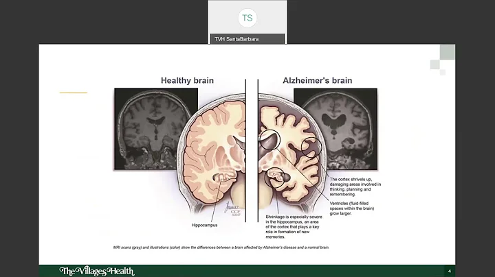Normal Aging vs Dementia