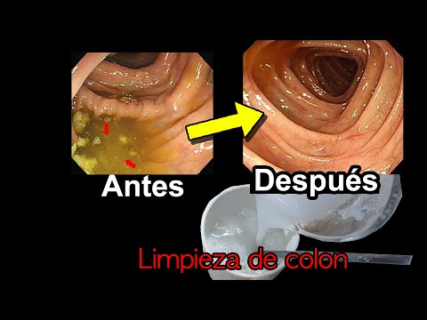 Limpieza de <strong>colon</strong> más rápida | REMEDIO CASERO para limpiar <strong>COLON</strong>