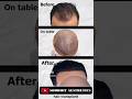 Hair transplant  journey at shobhit aesthetics