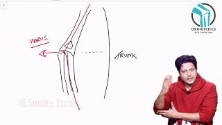 Cubitus Varus Deformity by Dr. Yusuf Ali Tyagi