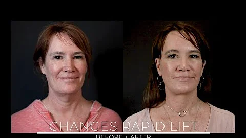Changes Rapid Lift - Dr. Gilbert Lee