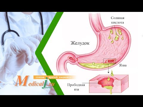 Прободная язва. Каковы причины? Какие симптомы? Как лечить?