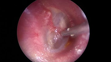 endoscopic T tube placement