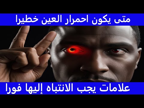 متى يكون احمرار العين خطيرا علامات يجب الانتباه إليها فورا