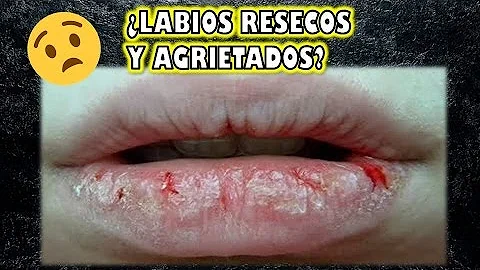 O que fazer quando os lábios do bebê estão ressecados?