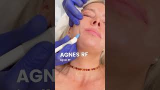 Download Lagu This 30-Minute Treatment Lifted My Saggy Jawline (AgnesRF Results You Won't Believe!) MP3