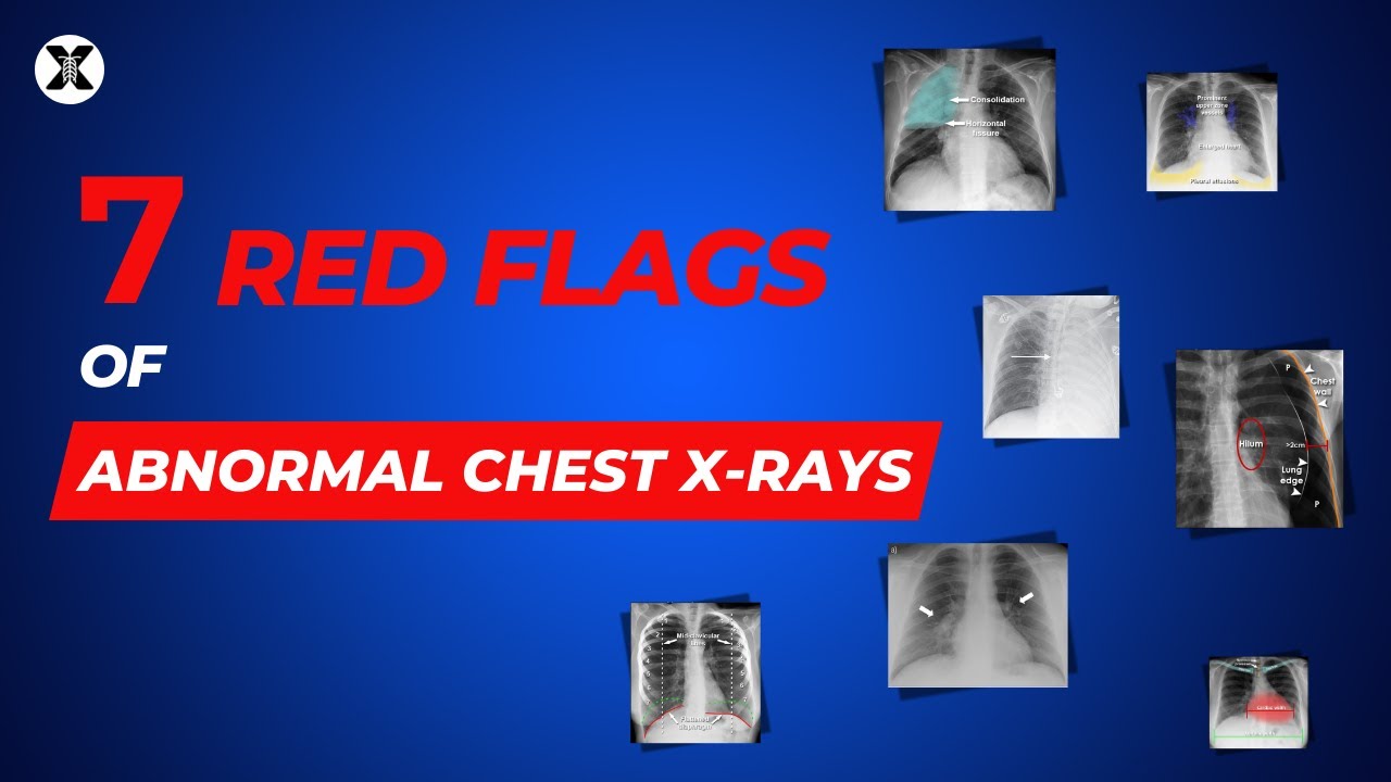 Normal vs  Abnormal Chest X Rays: 7 Critical Red Flags Explained
