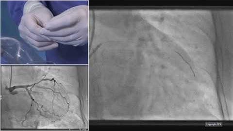 Left main and complex bifurcations stenting - EuroPCR 2019