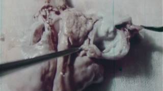 結核学術映画　空洞を探る 　日映科学映画製作所製作