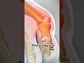 Bunion Correction Surgery (3D Animation)#bunionectomy #bunionectomyprocedure #bunioncorrection