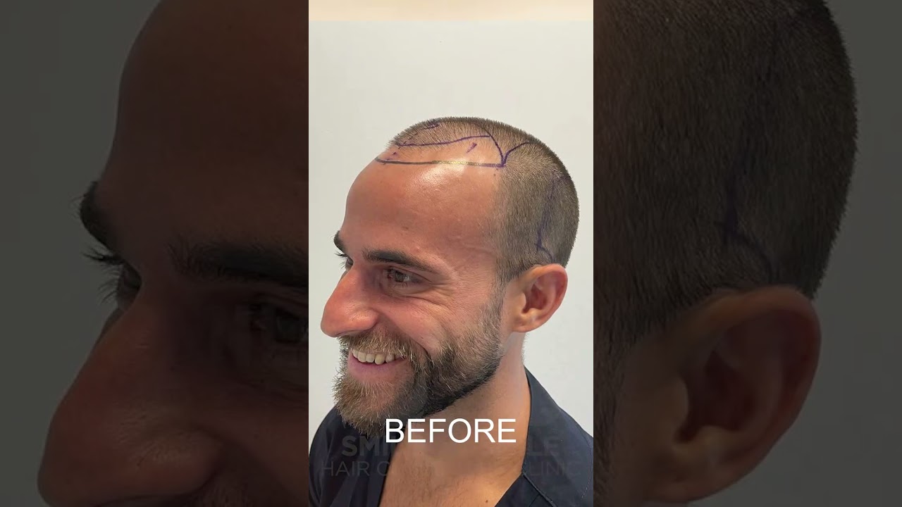 HAIR TRANSFORMATION 6 MONTHS UPDATE - HAIR TRANSPLANT - YouTube
