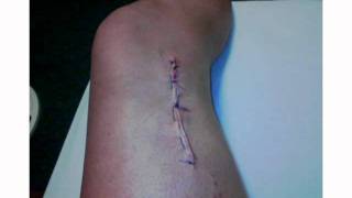 23 with melanoma