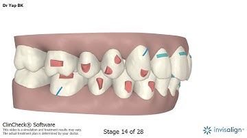 Invisalign clincheck video 1