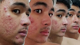 100 DAYS OF ISOTRETINOIN (TIMELAPSE) | Accutane/ Acnetrex Progress Video | KevInSeries screenshot 4