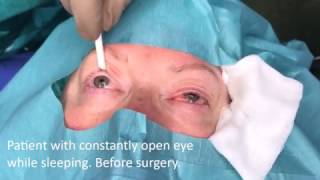 Eye Open While Sleeping Surgical Treatment - Dr Aral Lidmedcom