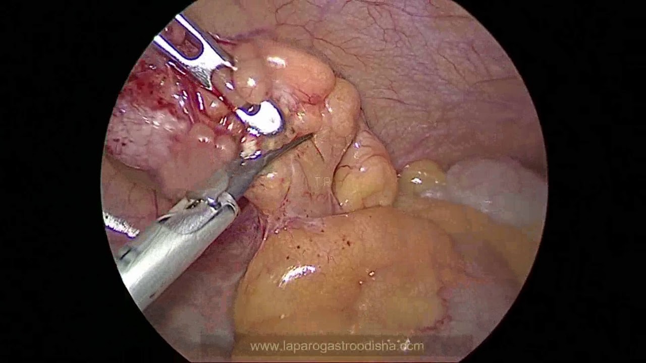 AppendicectomyLaparoscopic method and steps YouTube