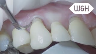 Tigon+ and periodontology tip 1P (English)