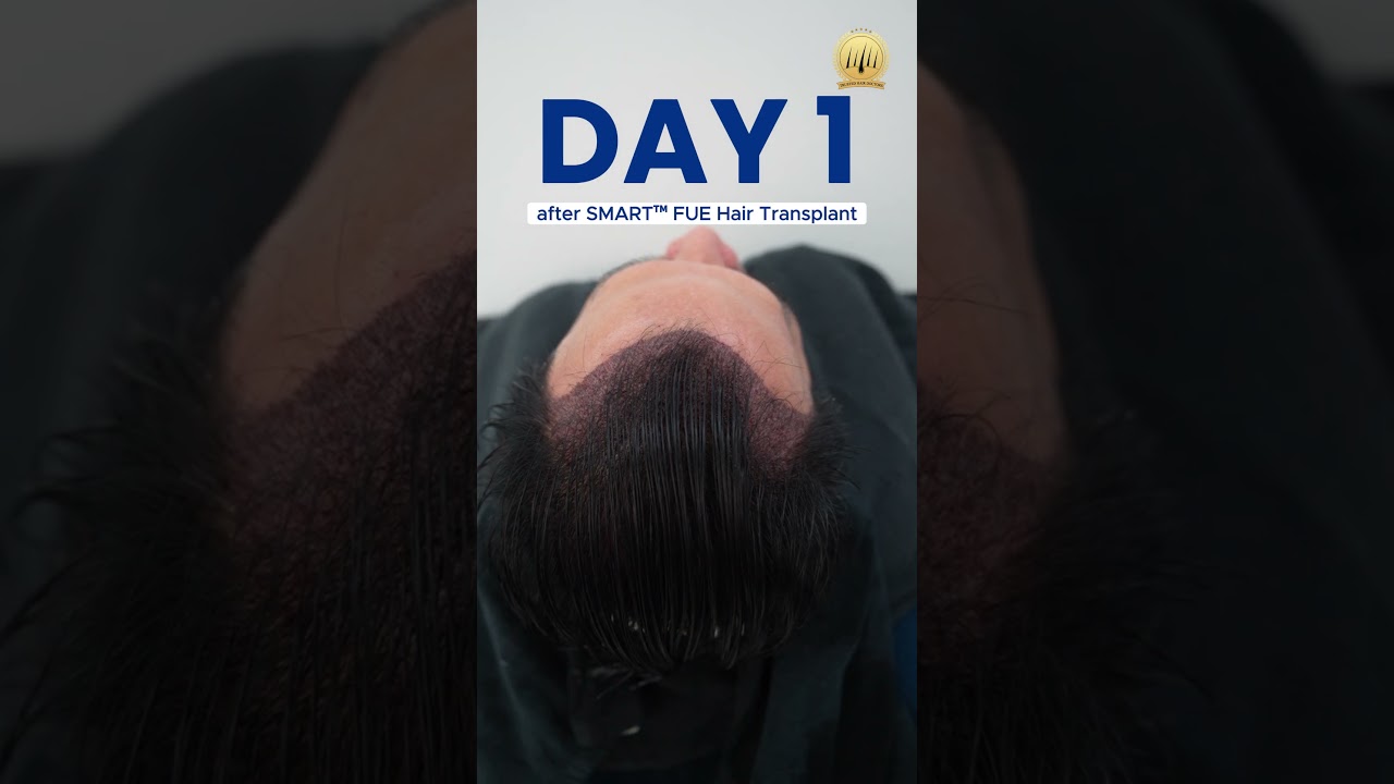 Hair Transplant Malaysia l Day 1 Post-Op: The Journey Begins! #hairtransplantmalaysia