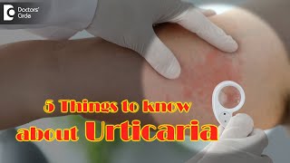 5 Things to Know about Urticaria |  - Dr. Divya Sharma|Doctors' Circle