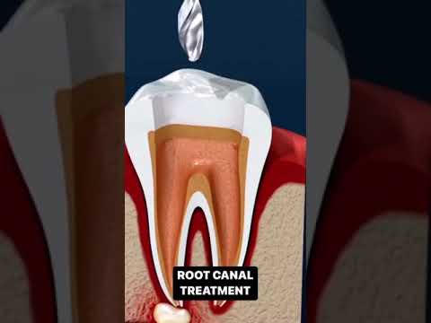 انیمیشن عصب کشی دندان عصب کشی ترفند دندان دکتر کنکور ایران