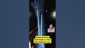 Tens nailing for forearm in children #shorts #medicine #orthopedicspecialist