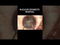 Catract operation Step by Step #visioncaremeerut