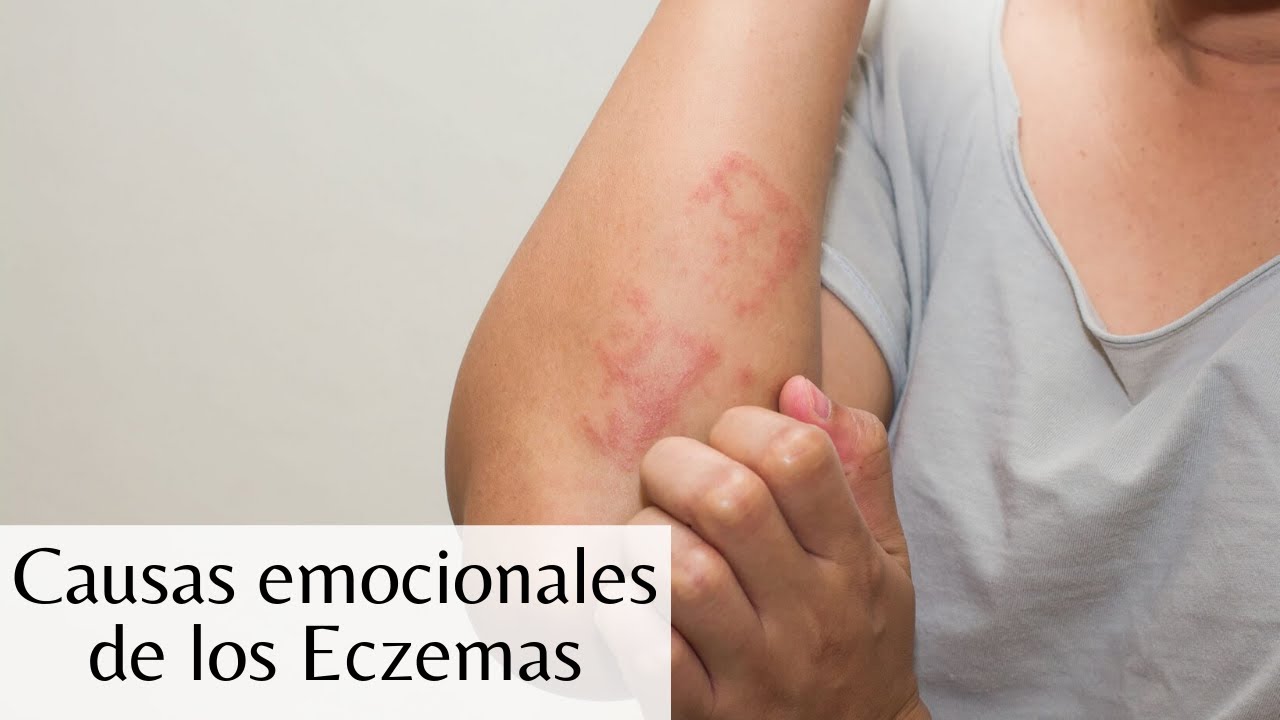 ¿Qué causa los Eczemas? YouTube