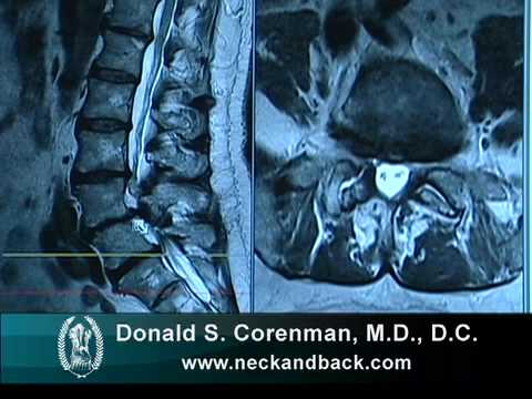 What Icd 10 Scoliosis