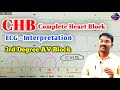 Complete heart block ecg  3rd degree av block ecg  chb ecg pstamil  ps