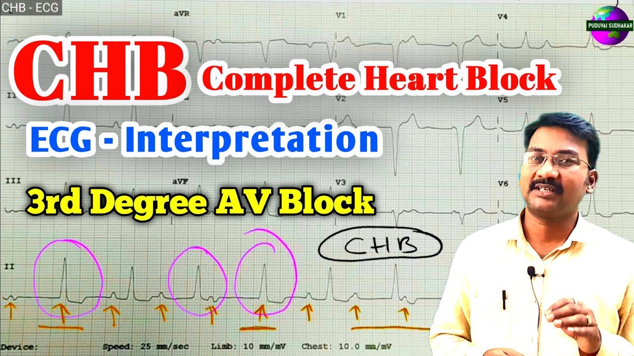 AV block: 3rd degree (complete heart block) • LITFL • ECG Library