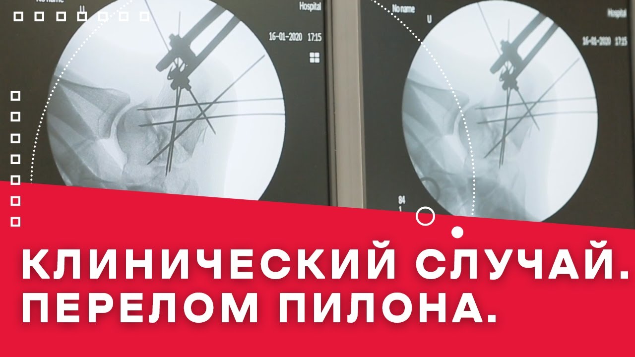 ПЕРЕЛОМ БЕРЦОВОЙ КОСТИ (ПЕРЕЛОМ ПИЛОНА)
