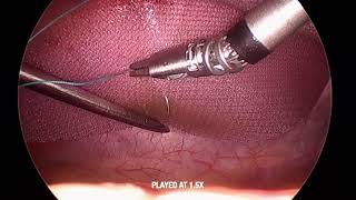 FlexDex - First Ventral Hernia with FlexDex - Dr. Robin Alley