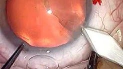General Principles Incision Phaco basic techniques