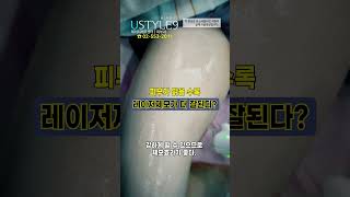 남자다리레이저제모 피부가 밝으면 효과가 더 좋아요! #shorts #레이저제모