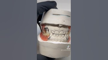 Upper Lower Vitallium Partials Wax Setup #vitallium # frameworks #dentures #tucsondentists #waxart