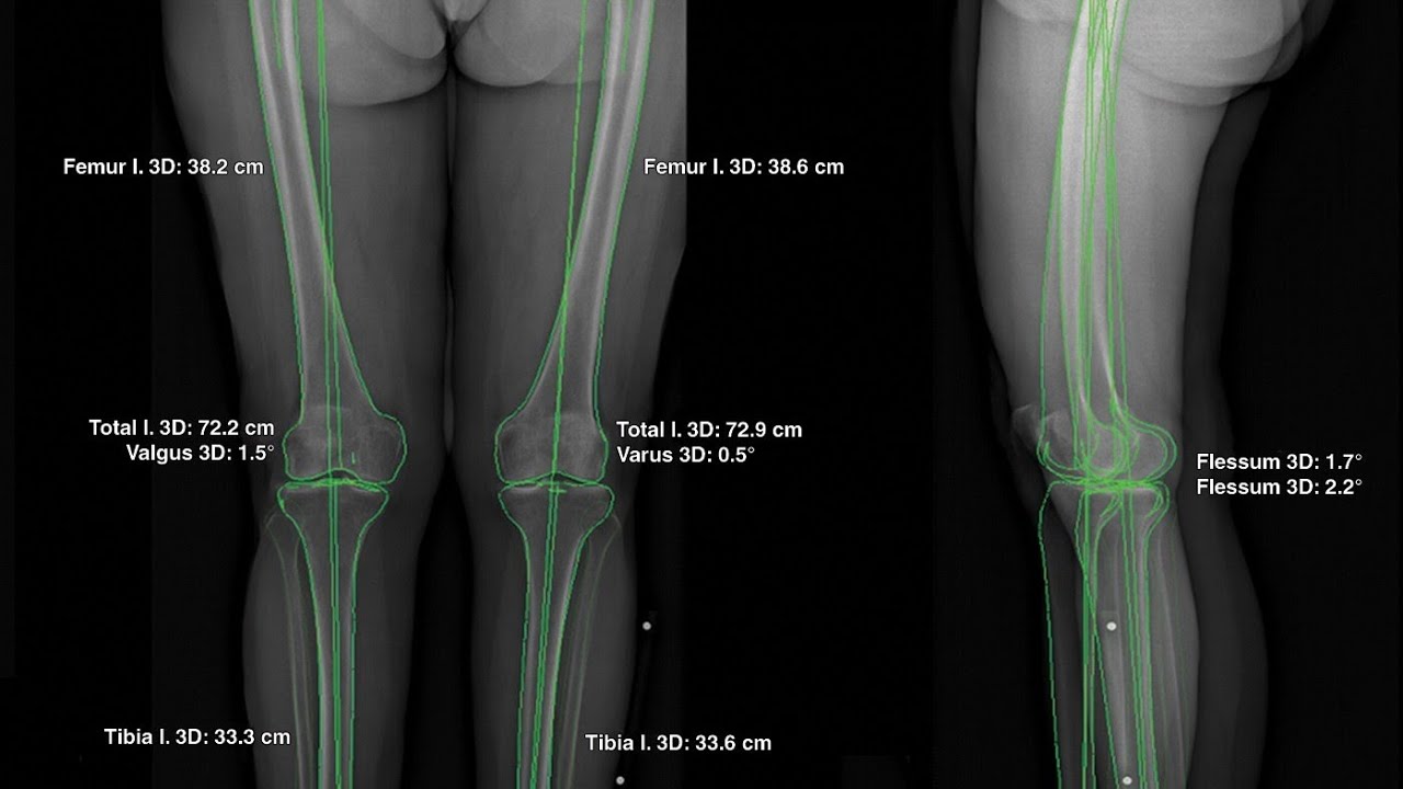 Scanogram Spanish Scanogram of the lower limb مراجعه سريعه علي - YouTube